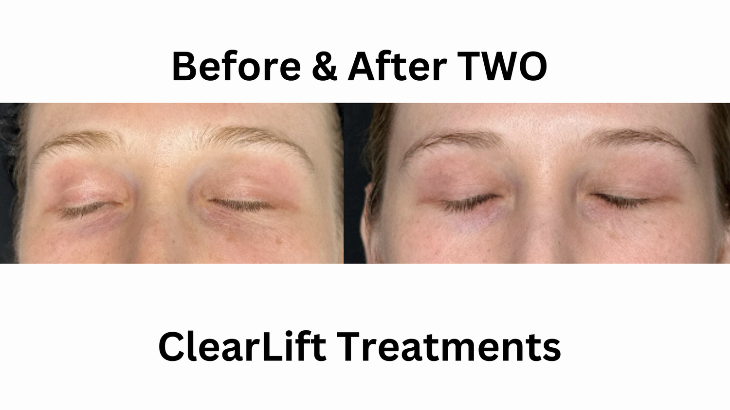 Clear Lift No Downtime Laser Facial — Take it Off PDX