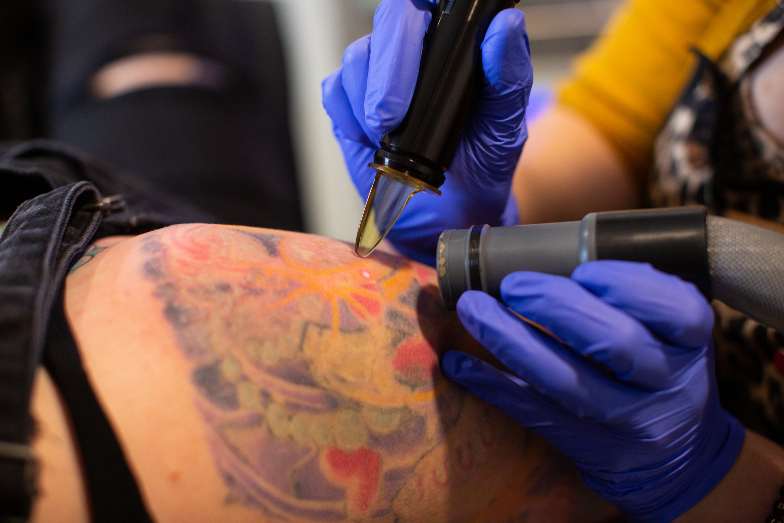 Portland Tattoo Removal — Take it Off PDX