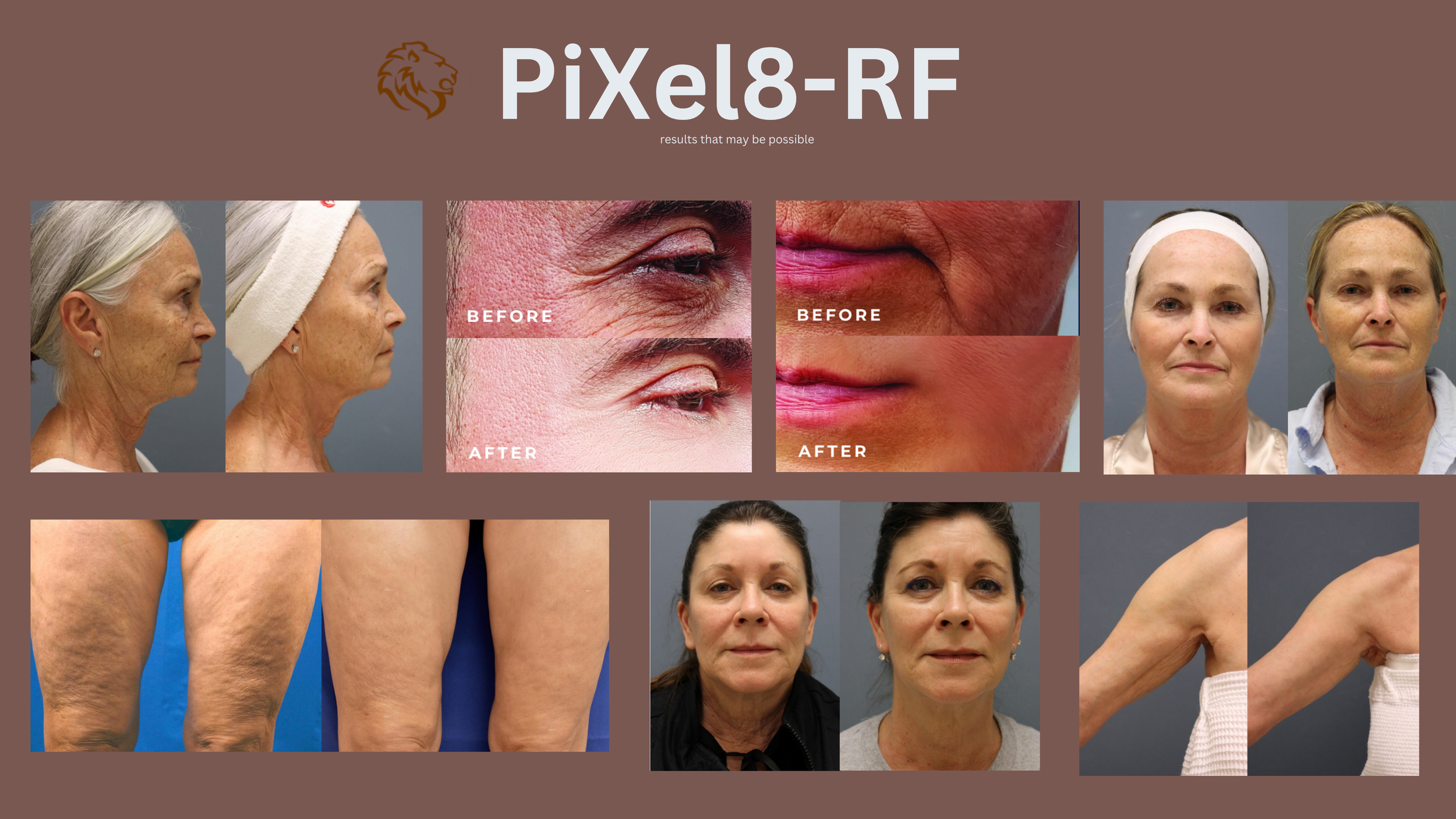 RF Microneedling with Cosmopolitan Magazine's favorite device — Take it ...