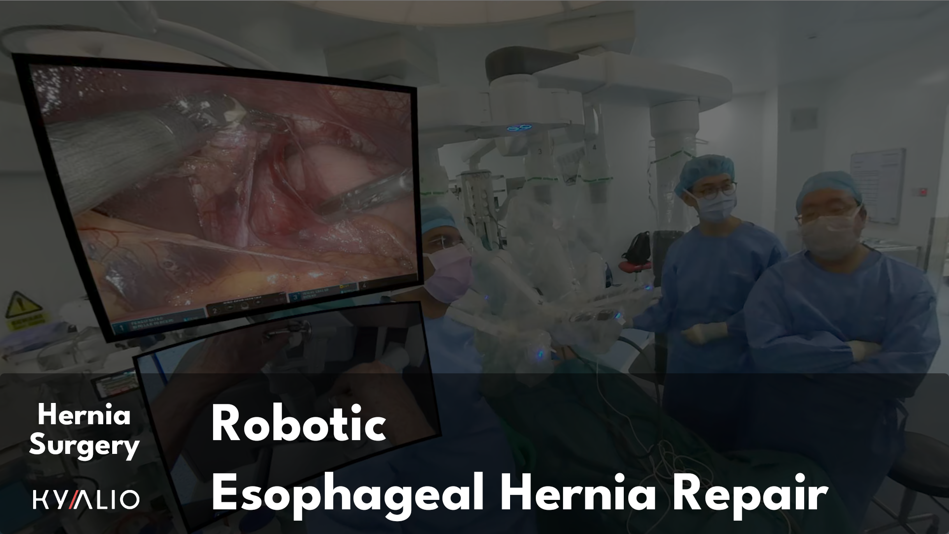 SG1_38_NUH_Lomanto_Robotic_Esophageal_Hernia_Repair_06062023_C.png
