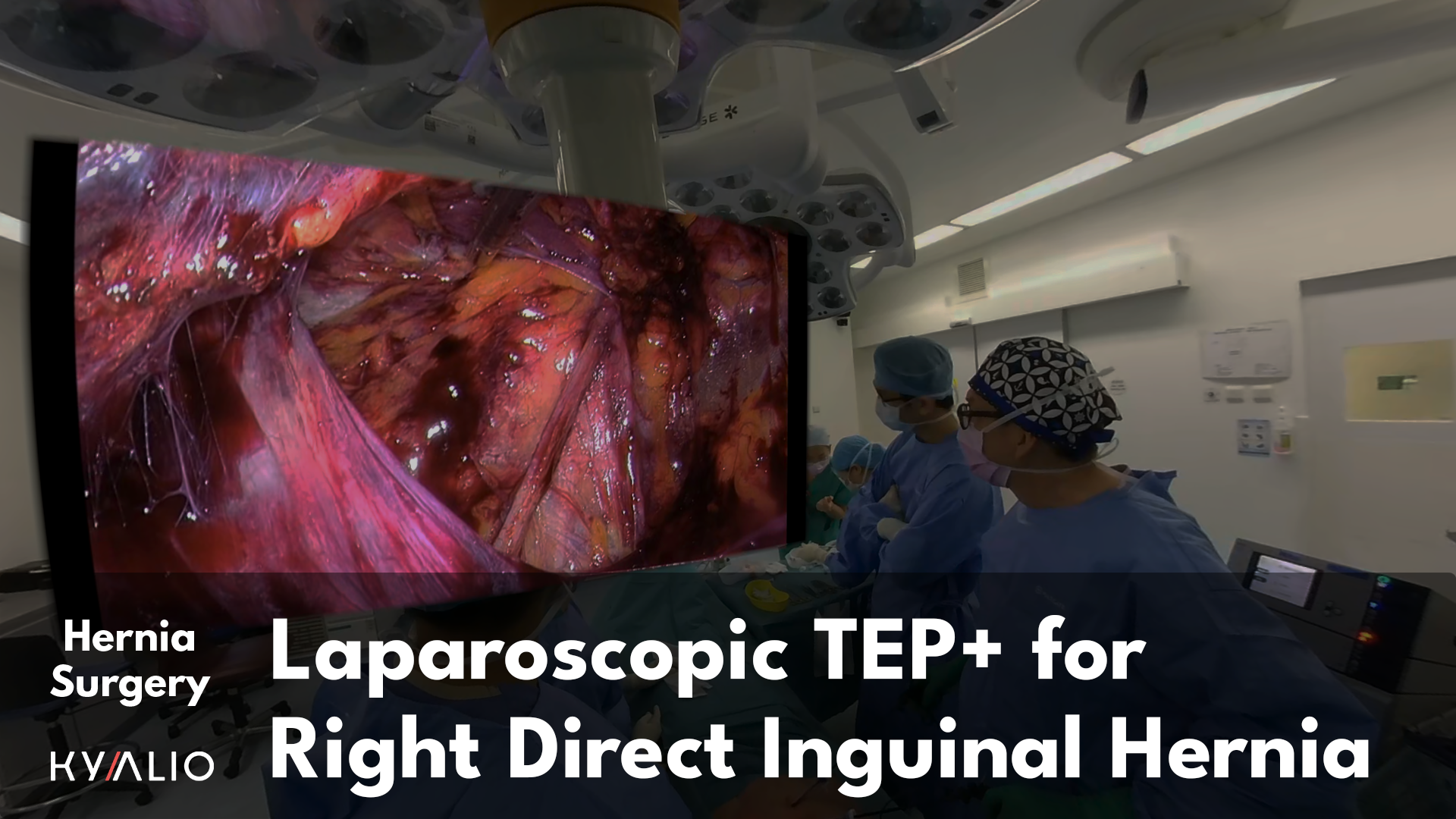 Davide Lomanto_Right_Direct_Inguinal_Hernia_TEP_plus_1920x1080.png