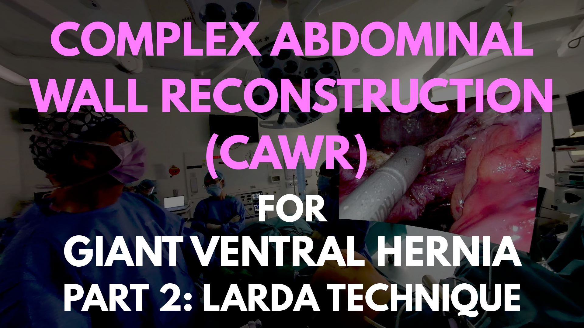 CAWR for Giant Ventral Hernia_part2.png