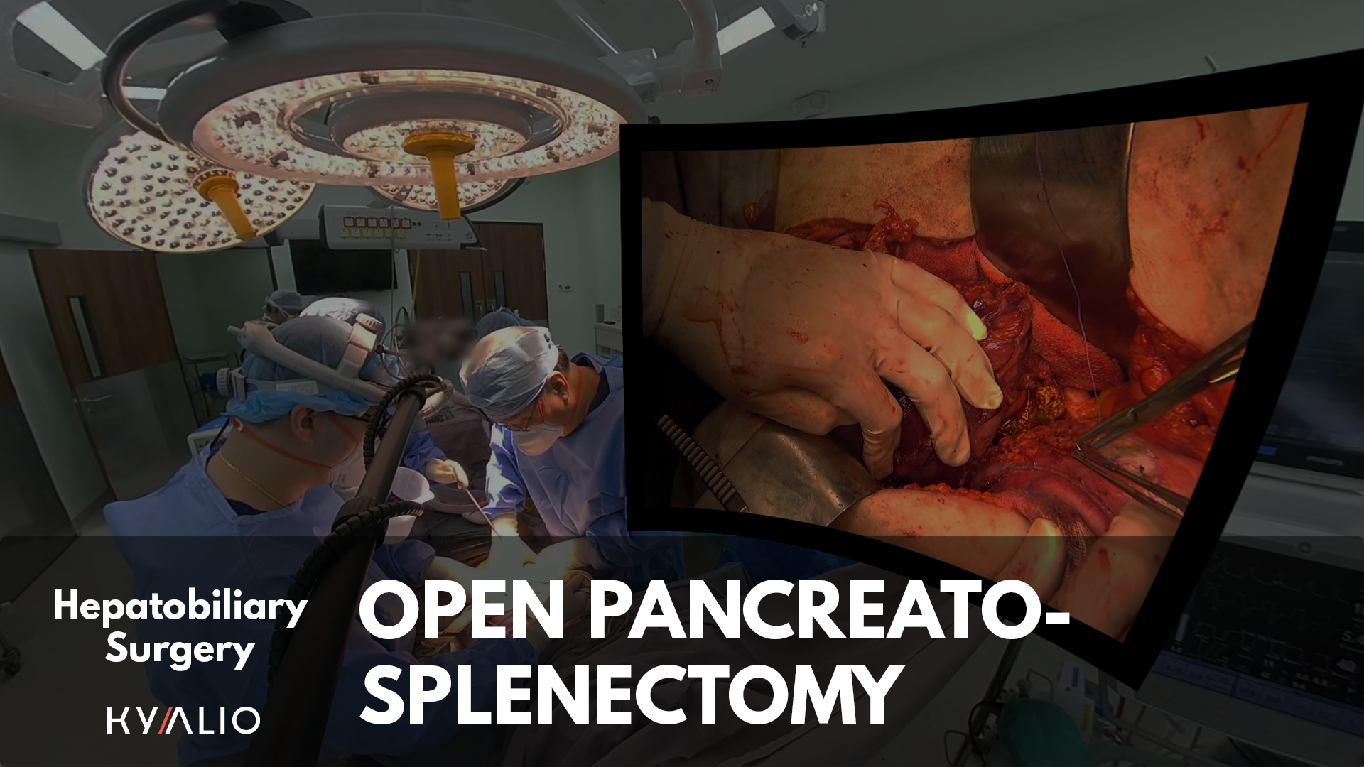 Pancreatosplenectomy_1920x1080.png