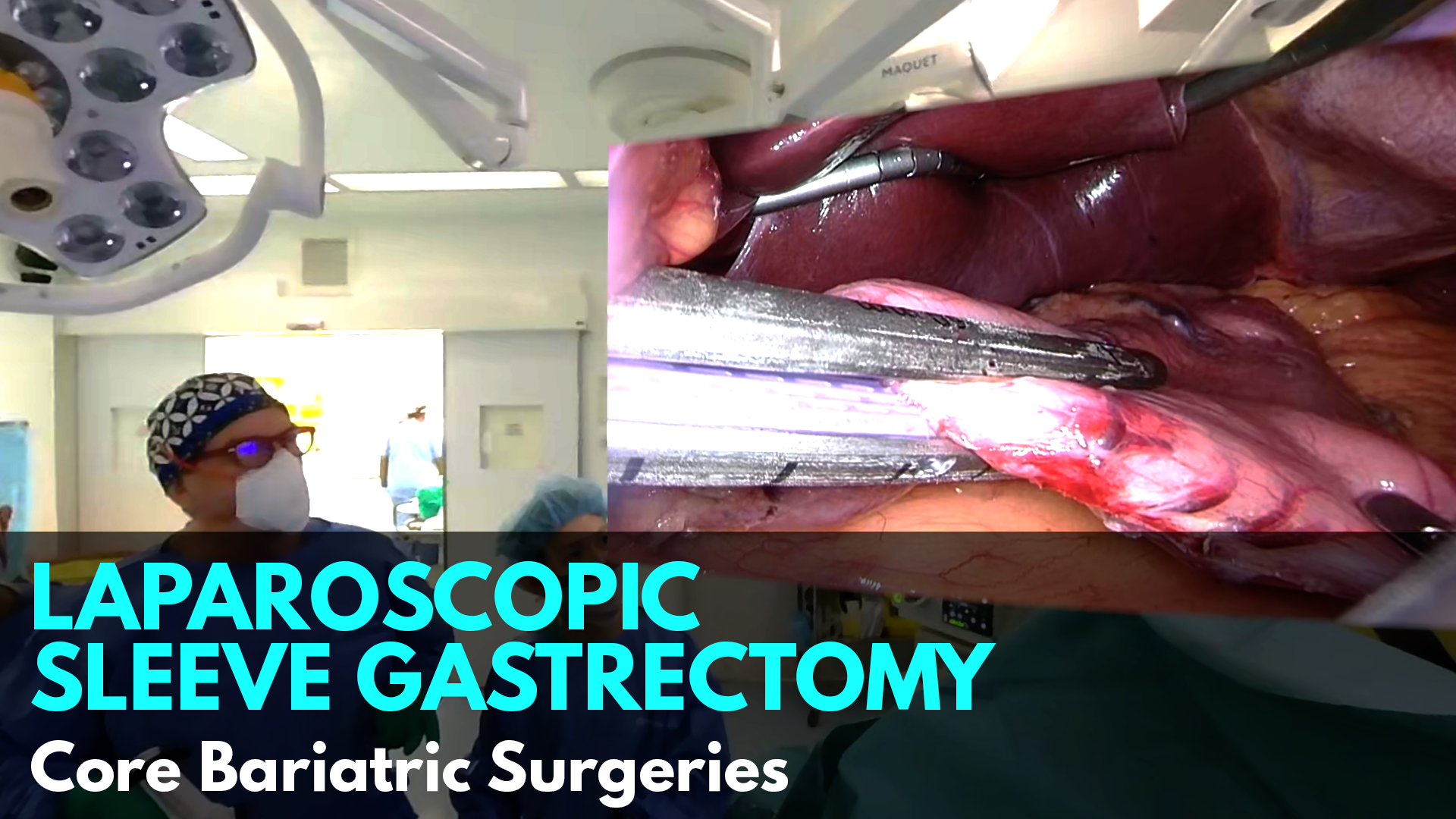 Davide Lomanto_Laparoscopic Sleeve Gastrectomy.png