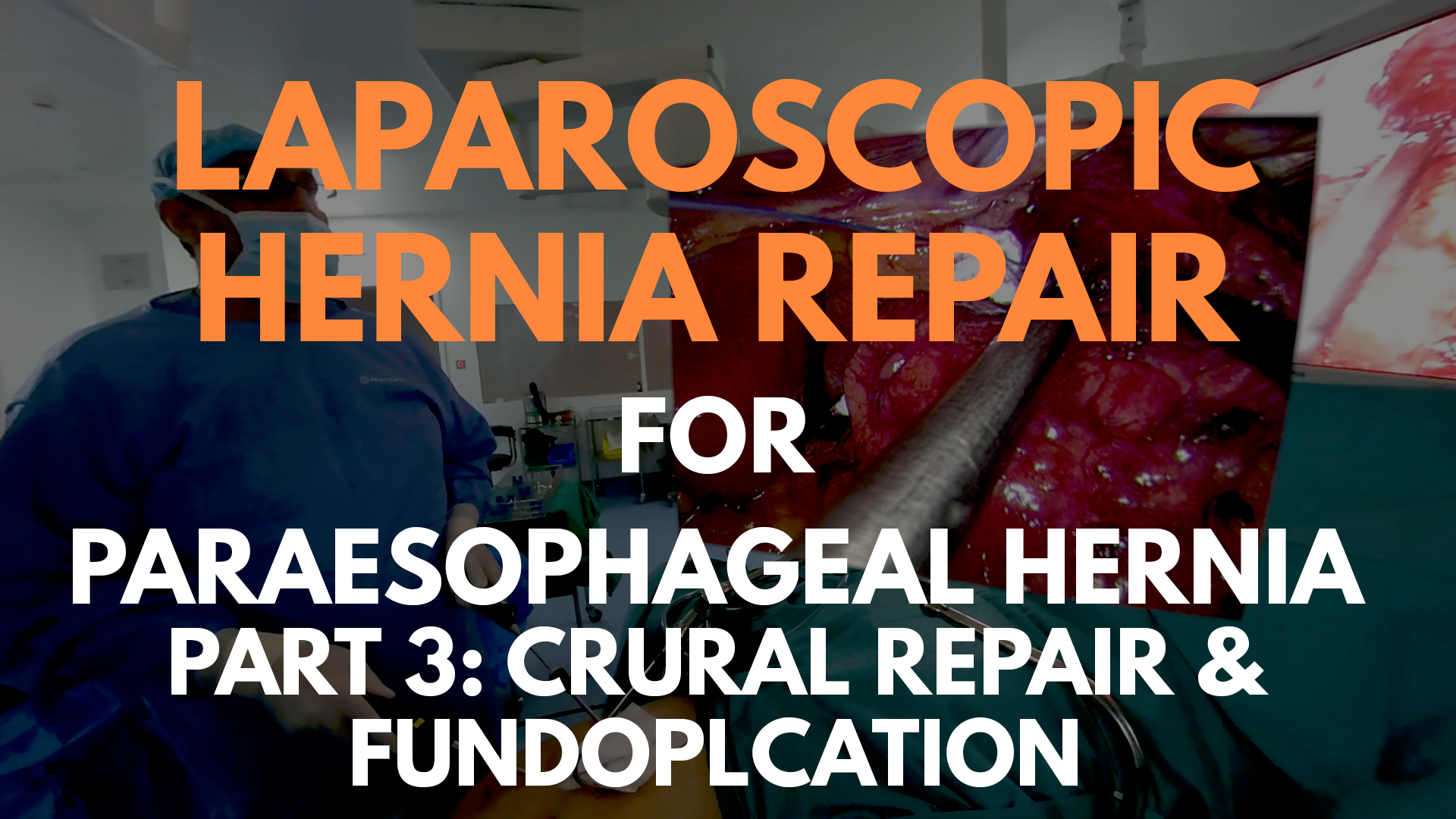 Laparoscopic Hernia Repair for Paraesophageal Hernia_part 3.png