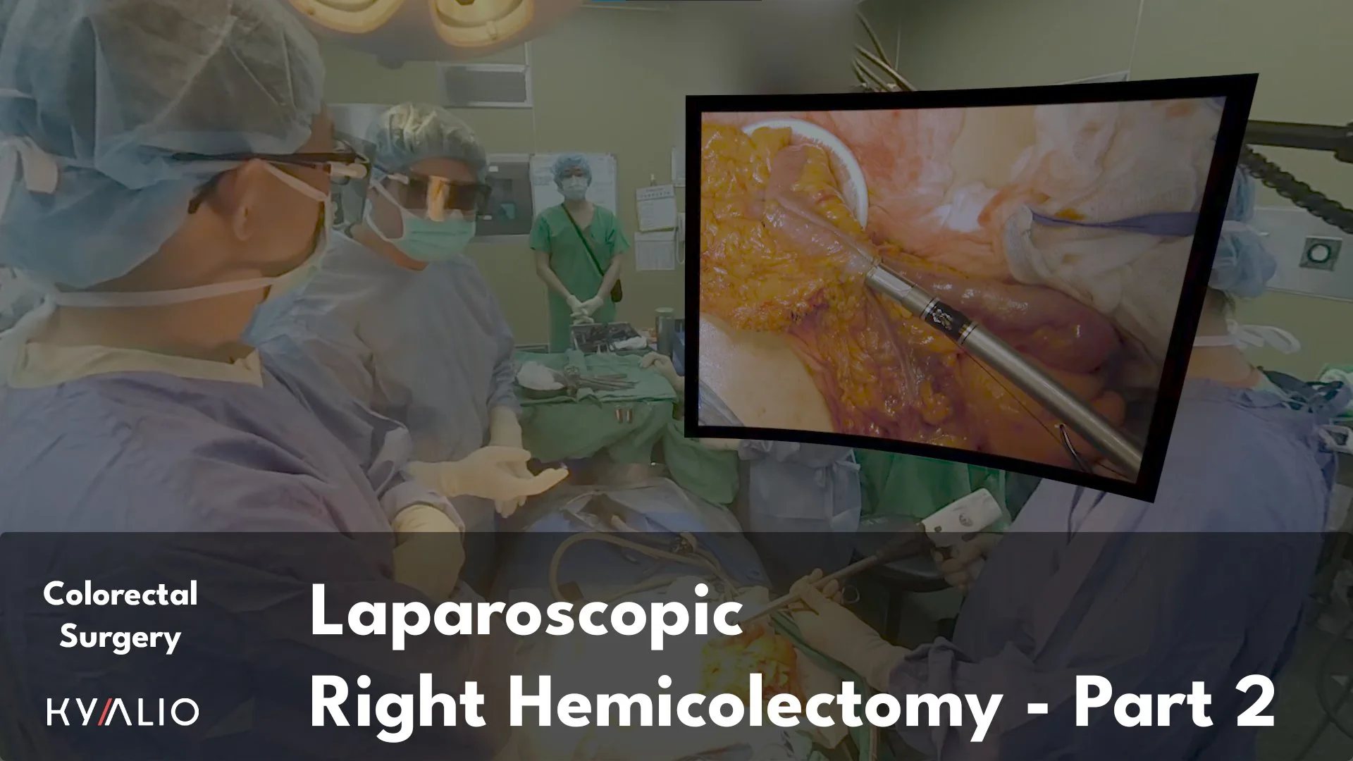TW1_121_NCKU_Chen_Po_Chuan_Laparoscopic_Right_Hemicolectomy_20092023_Part_2_Thumbnail_1.jpg