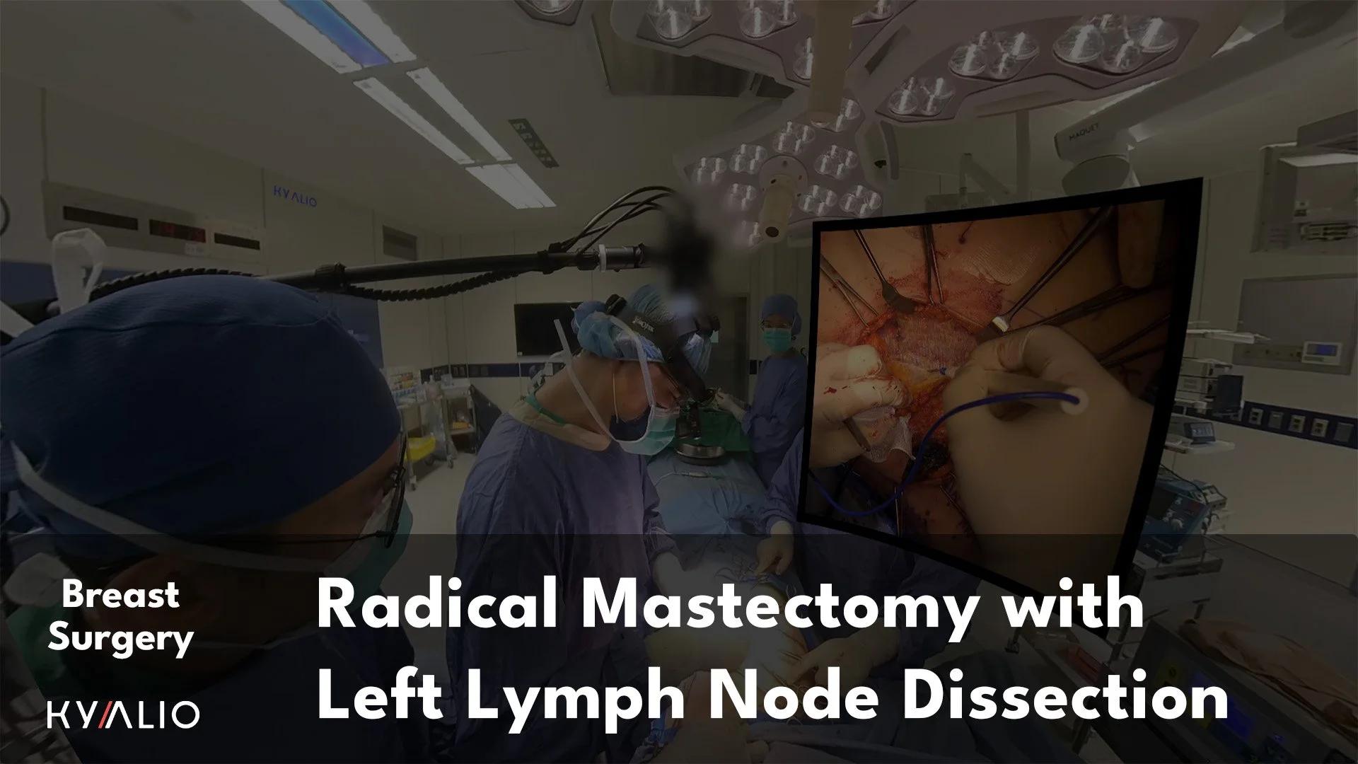 TW1_75_NCKU_Lee_Kuo_Ting_Radical_Mastectomy_with_Left_Lymph_Node_Dissection_16022023_thumbnail.jpg