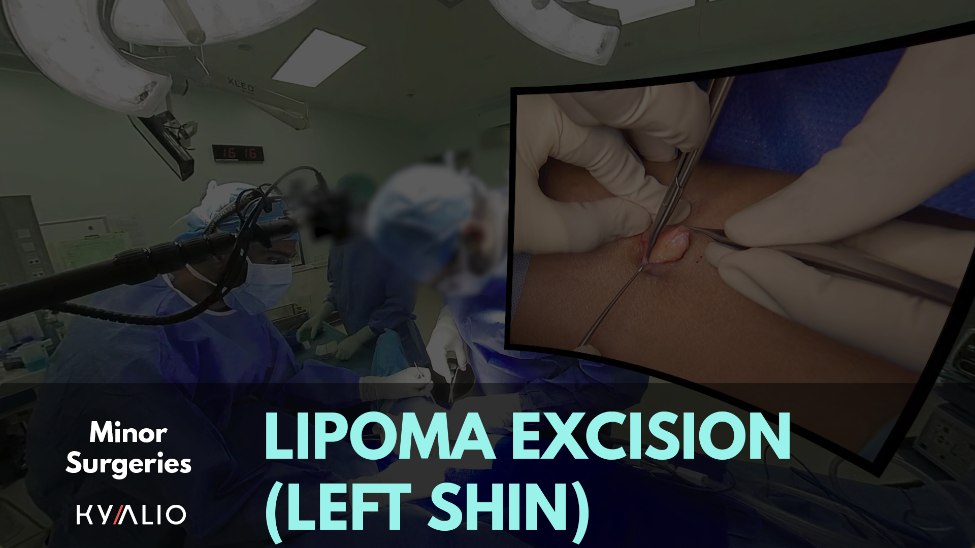 Left_Shin_Lipoma_Excision_TN.png