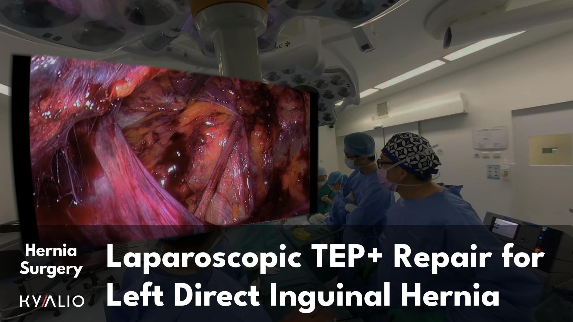 Laparoscopic TEP + Repair for Left Direct Inguinal Hernia.png