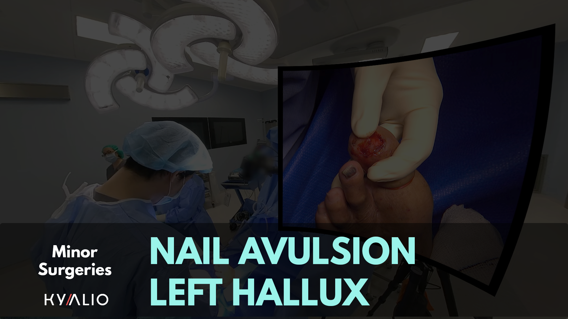 Toenail Avulsion of Left Big Toe_TN.png
