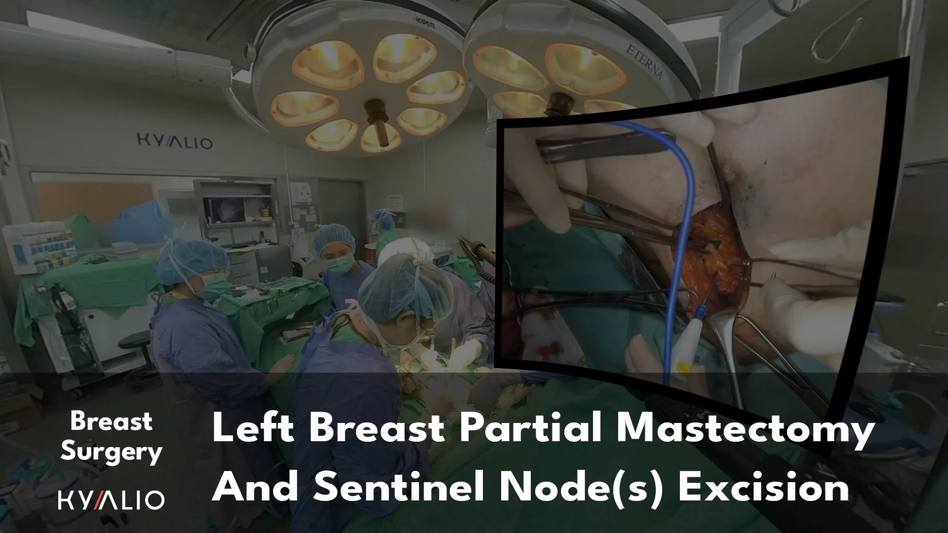 TW1_110_NCKU_Lee_Kuo_Ting_Left_breast_partial_mastectomy_and_sentinel_nodes_excision_28042023_Thumbnail_Template.jpg