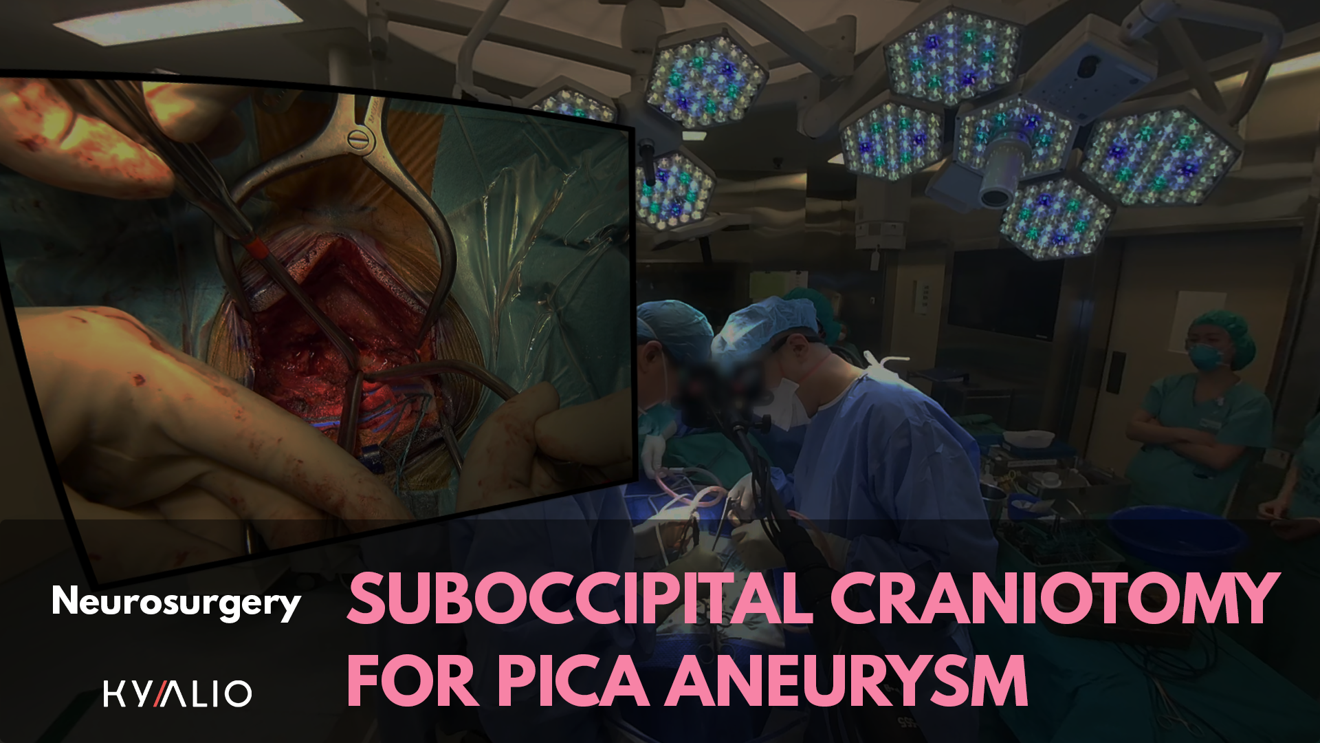 xSuboccipital_Craniotomy_for_PICA_Aneurysm_1920x1080.png