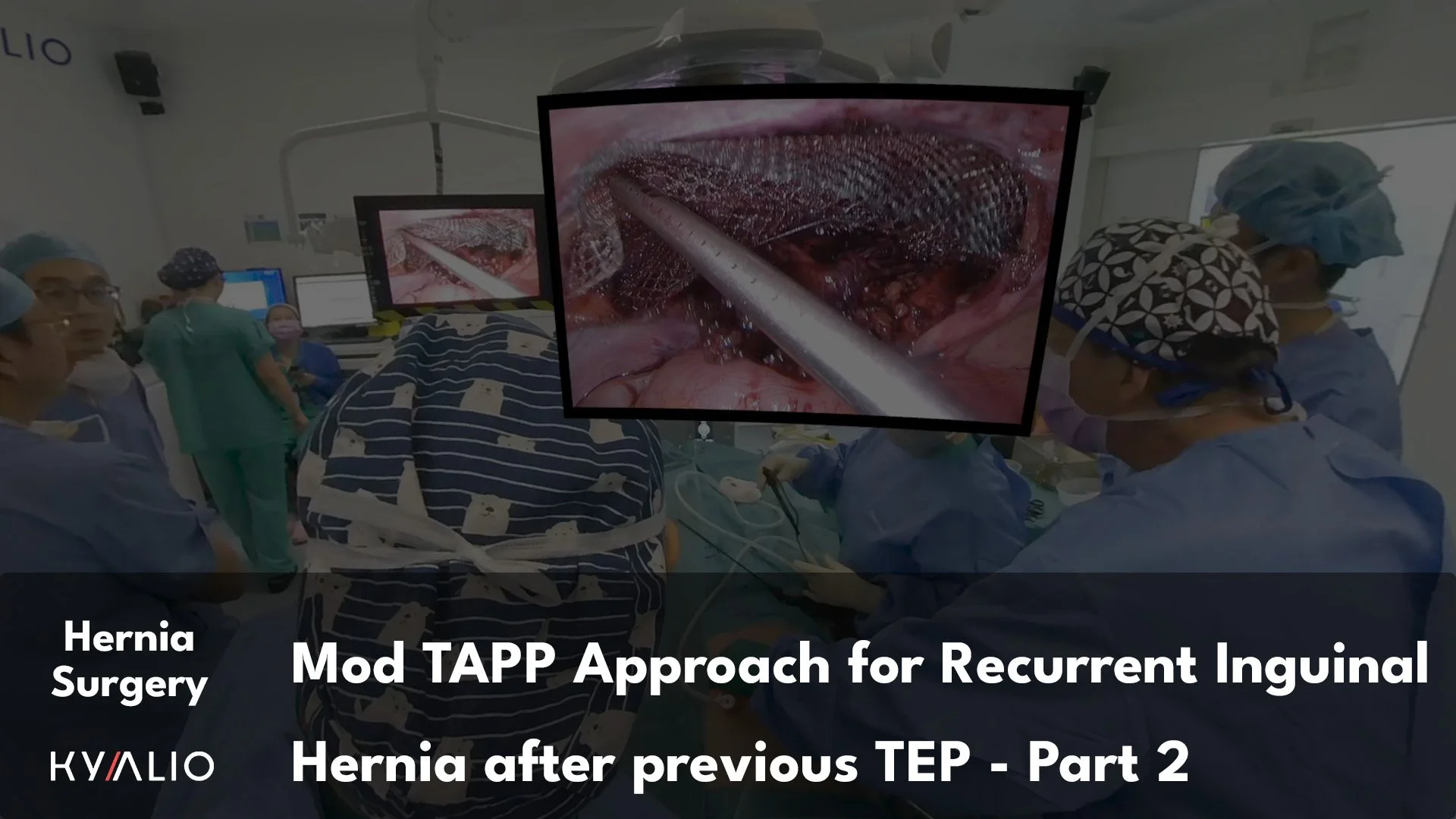 SG1_44_NUH_Lomanto_Mod_TAPP_Approach_for_Recurrent_Inguinal_Hernia_after_previous_TEP_P2_TN.jpg