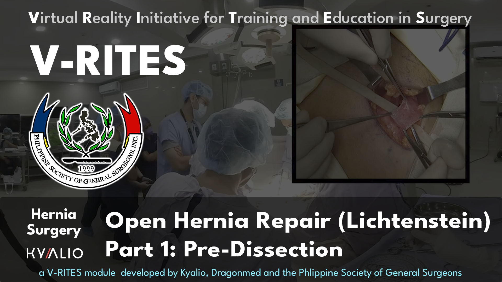 Jose Macario Faylona_Open_Hernia_Repair_Lichtenstein_P1_predissection.jpg