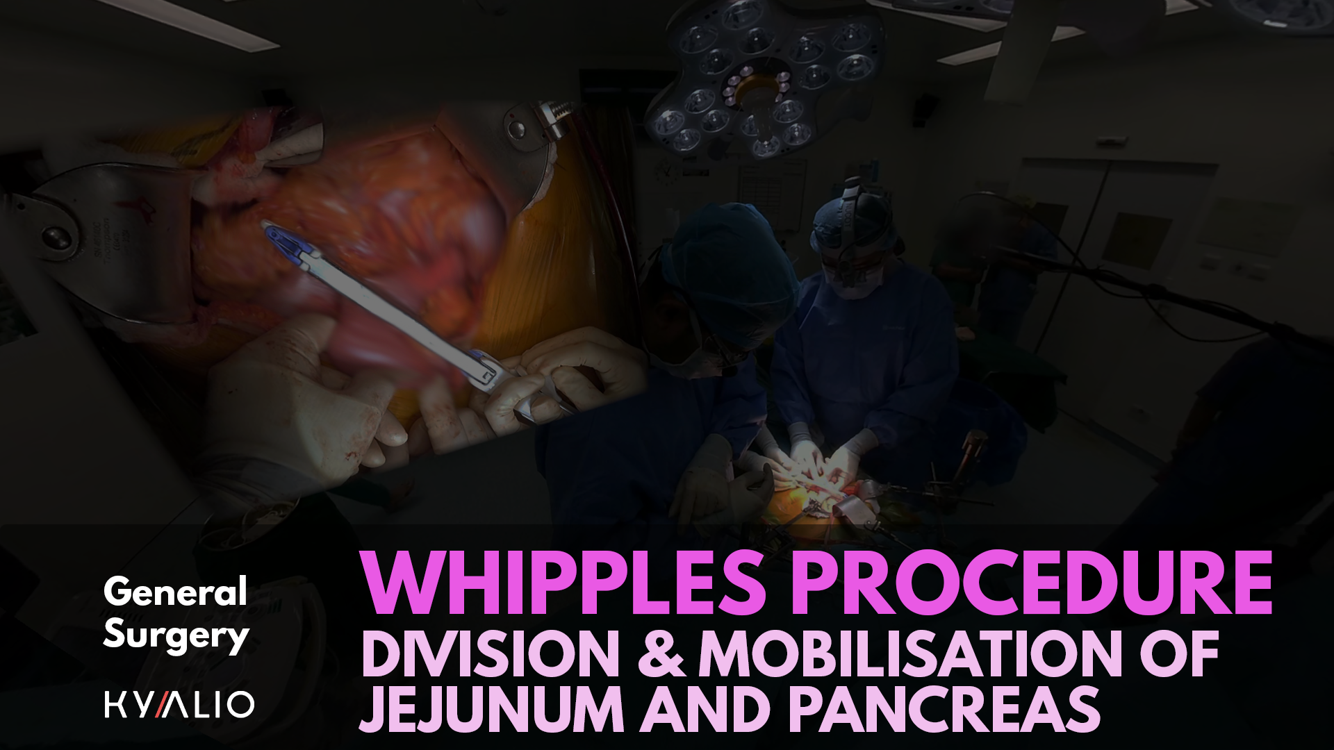 Shridhar Iyer_Whipples_Procedure_P1_TN.png