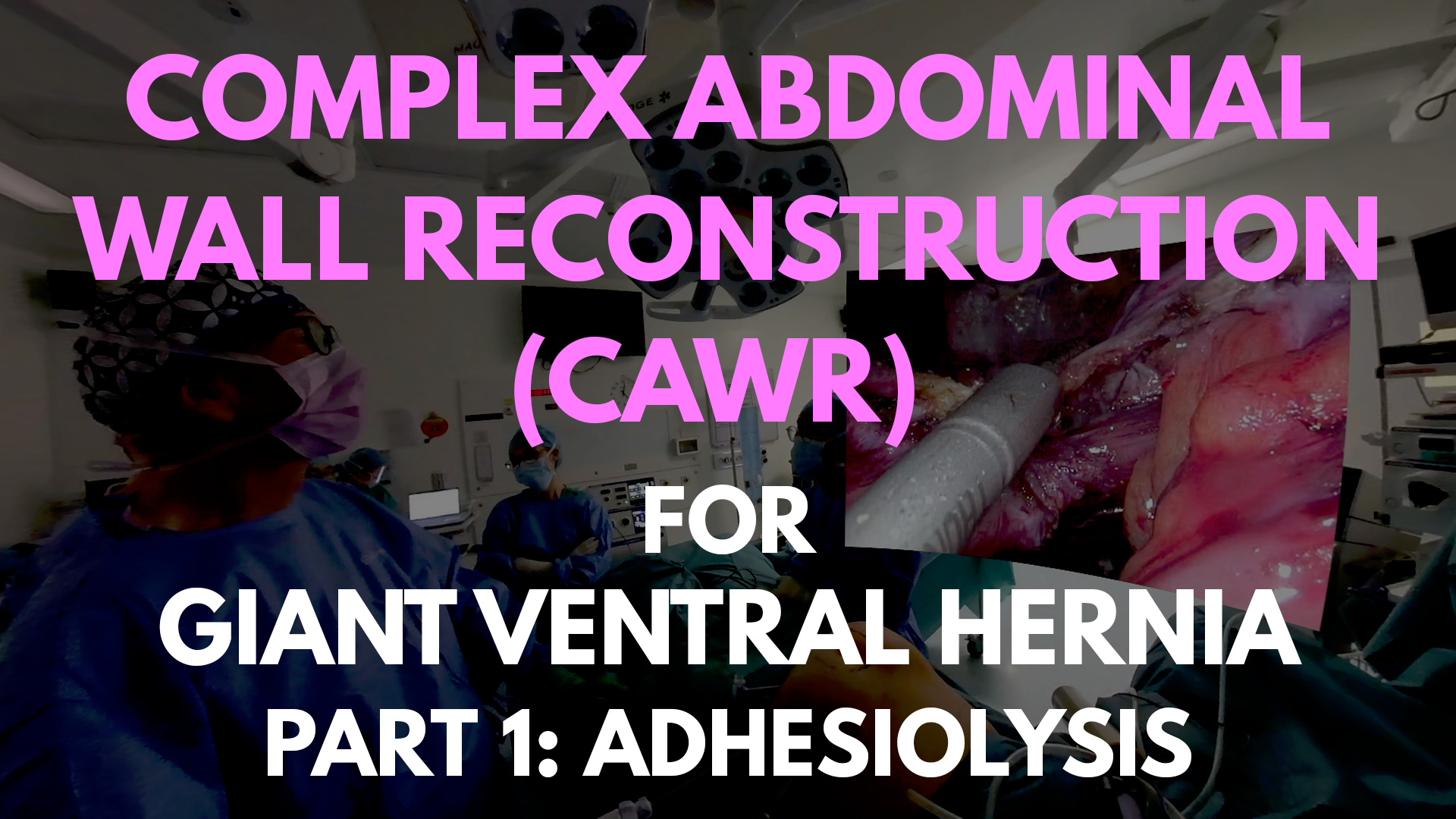 CAWR for Giant Ventral Hernia_part1.png