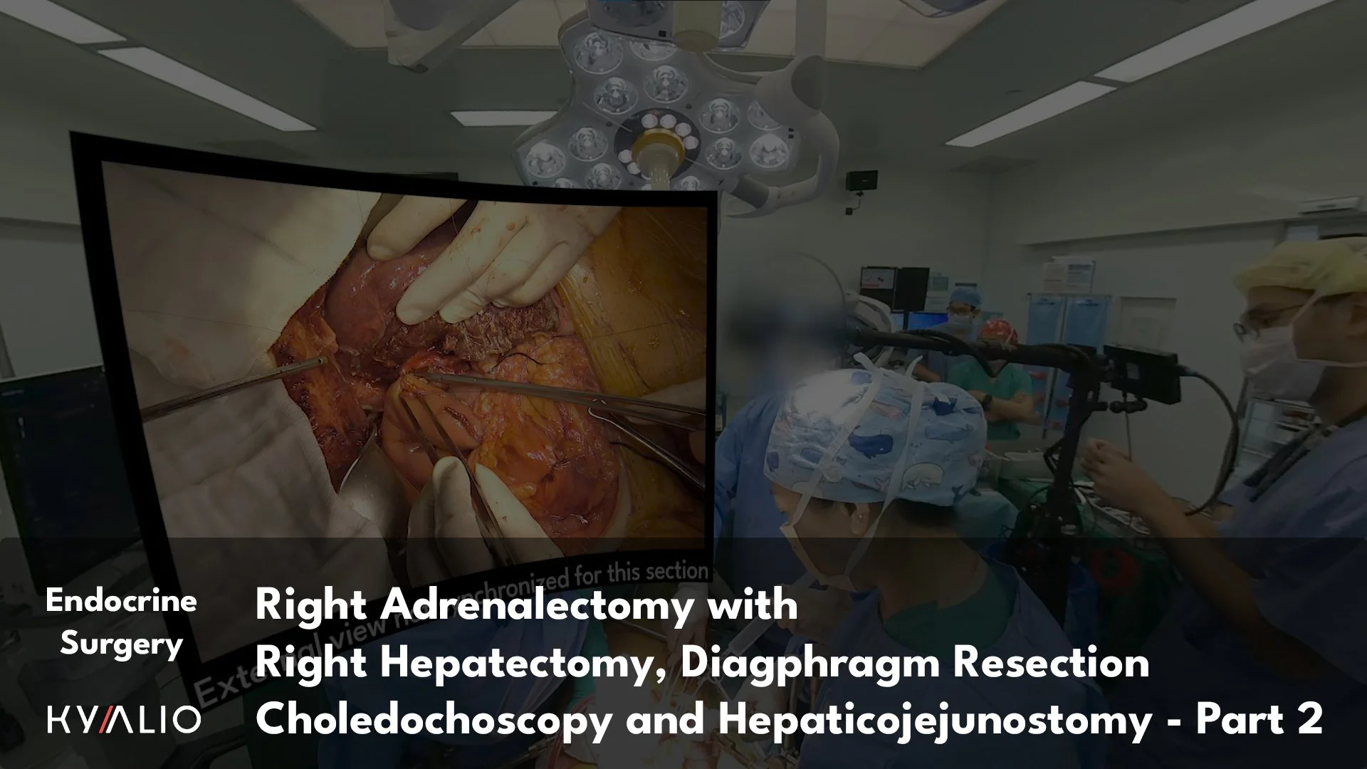 SG1_50_NUH_Shridhar_Right_Adrenalectomy_with_Right_Hepatectomy_Part_2_Thumbnail.jpg