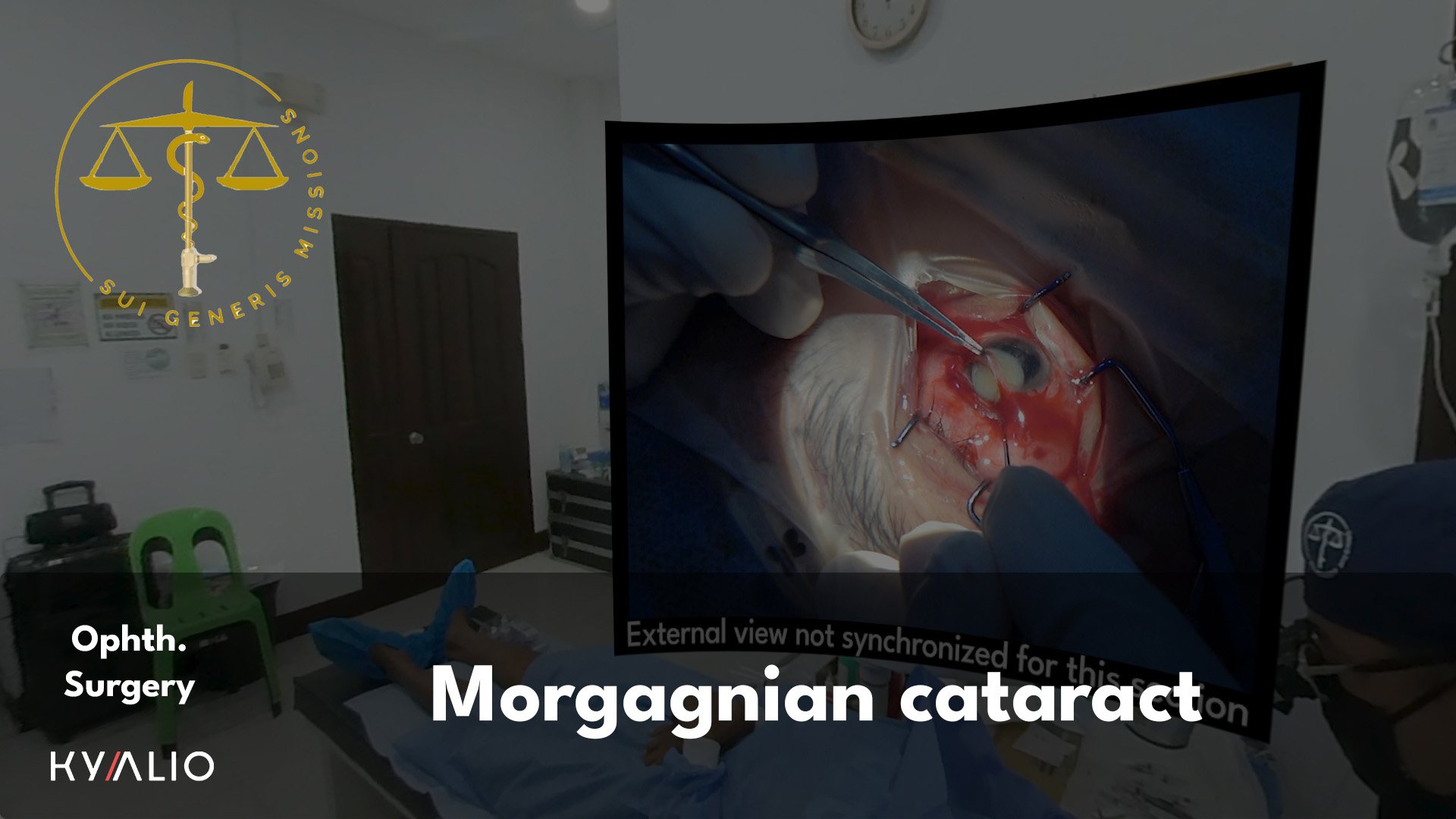 PH10_28_SGM_Morgagnian_Cataract_22082025_TN_new.jpg