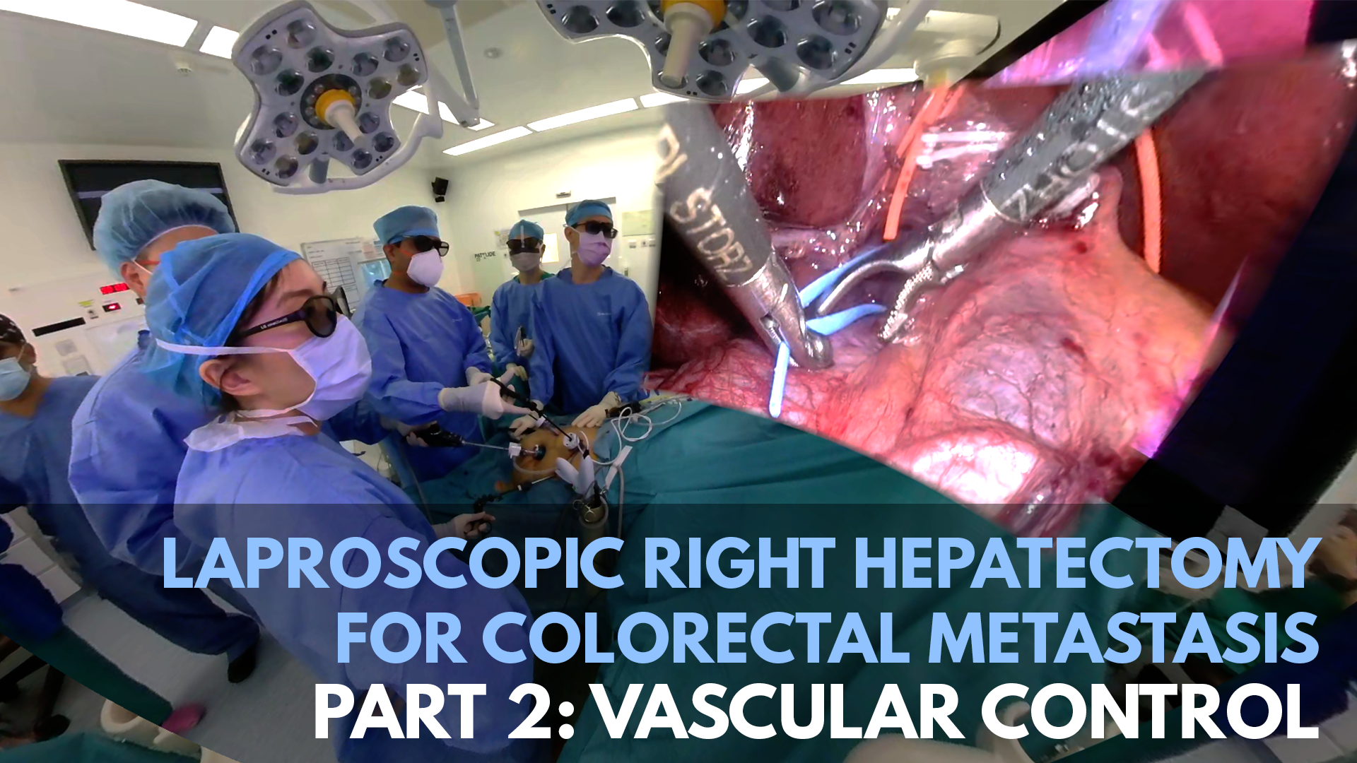 Laparoscopic Right Hepatectomy For Colorectal Metastasis_P2_TN.png.png
