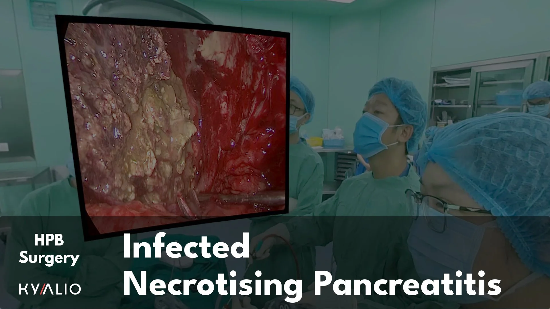 VN1_74_HCM-UMC_Tran Huy_Necrotizing_Pancreatitis_31082022_Thumbnail_1.jpg