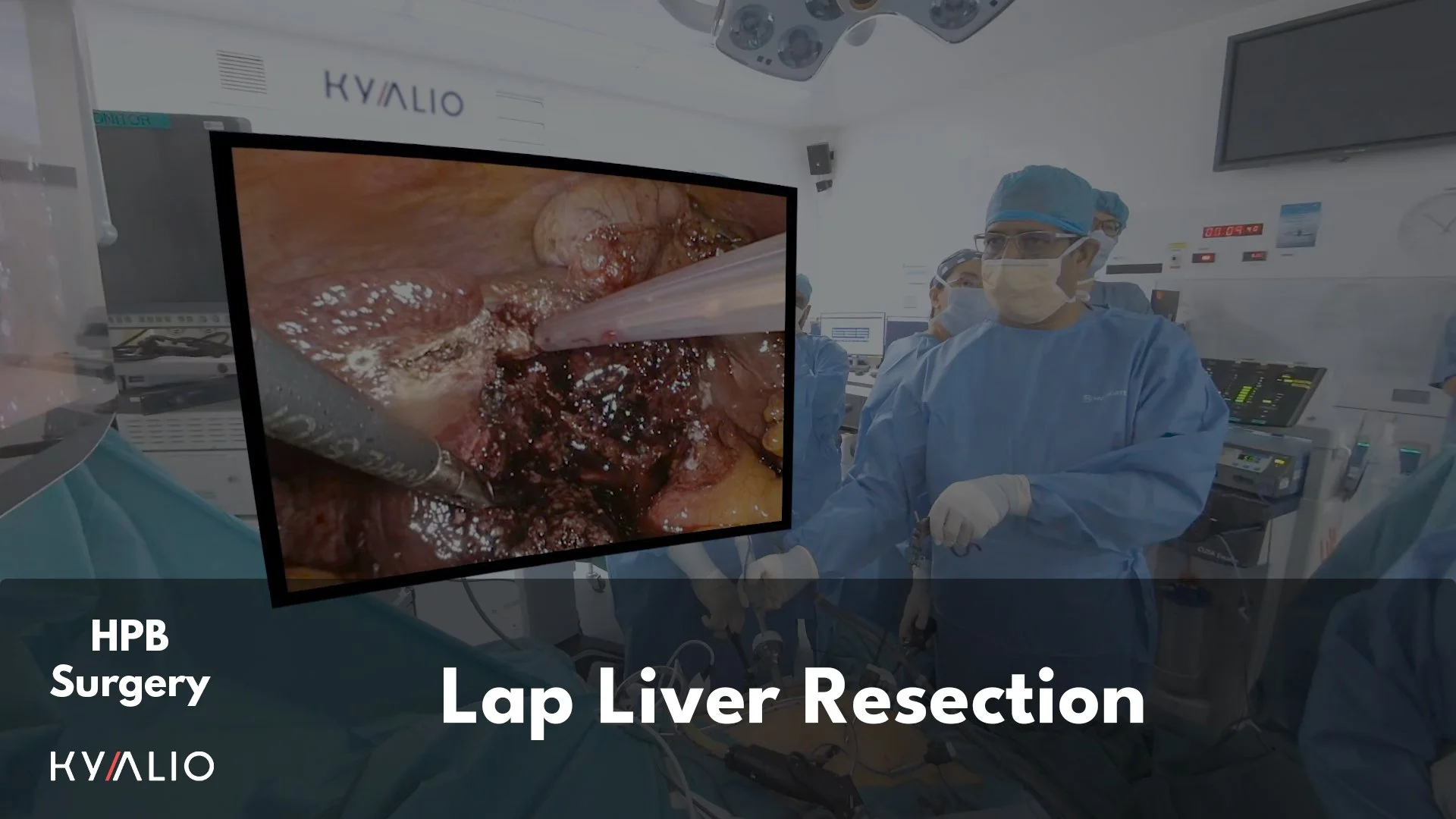 SG1_49_Shridhar_Iyer_Lap_Liver_Resection_23102024_Thumbnail_1.jpg