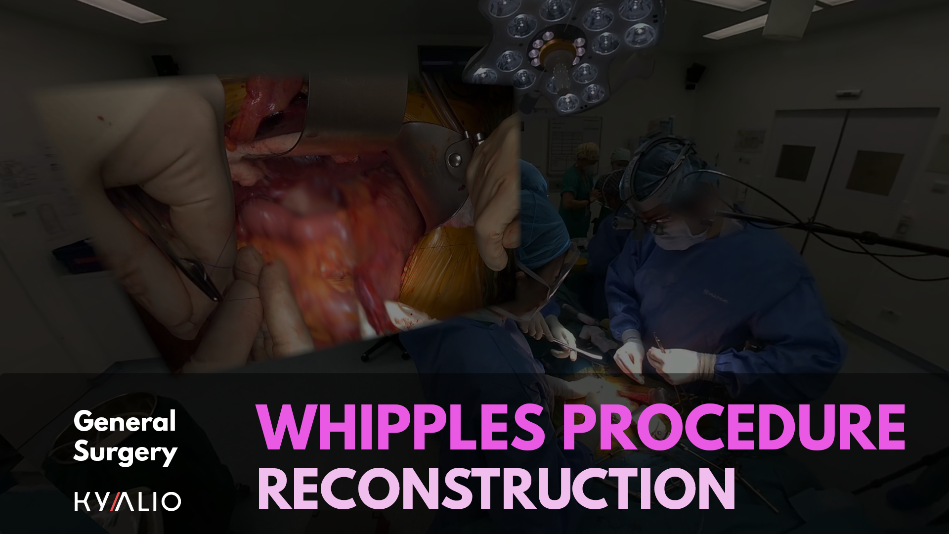 Shridhar Iyer_Whipples_Procedure_P2_TN.png