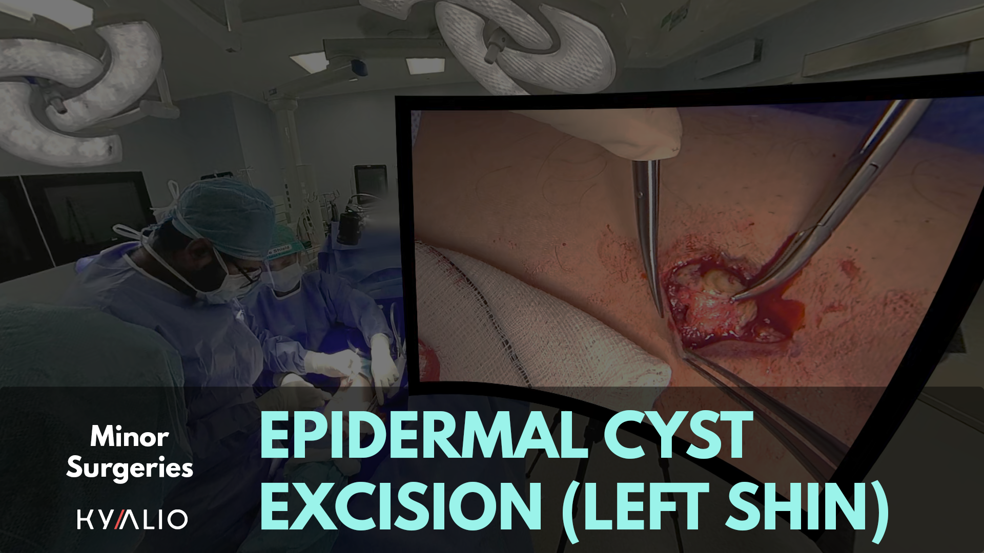 Shin_Epidermal Cyst Excision_Punctum_Cyst_TN.png