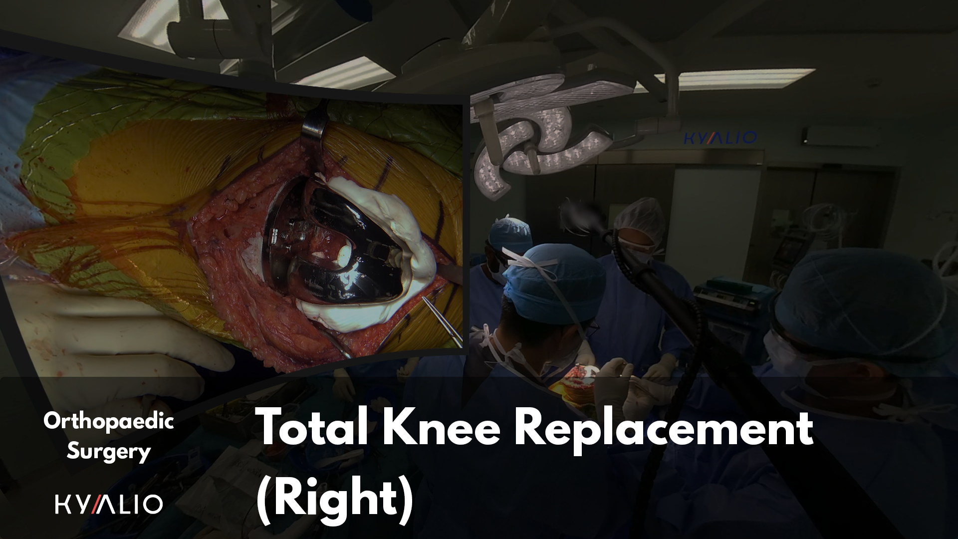 Total Knee Replacement.png