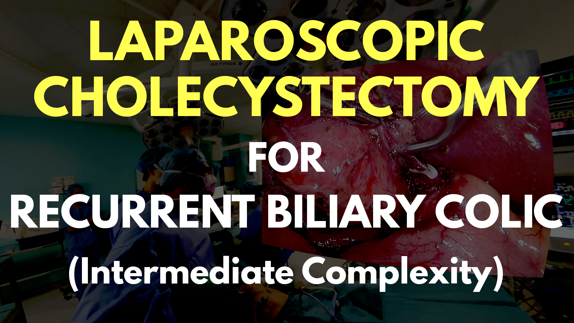 Laparoscopic Cholecystectomy for Recurrent Biliary Colic.png