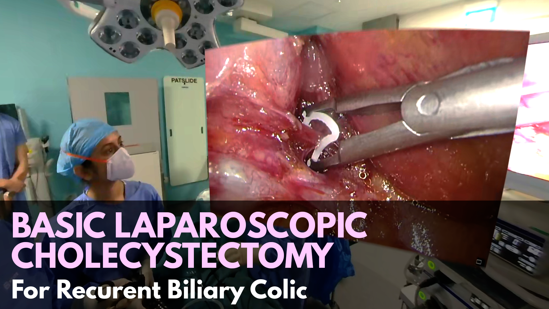 Basic Laparoscopic Cholecystectomy for Recurent Biliary Colic .png