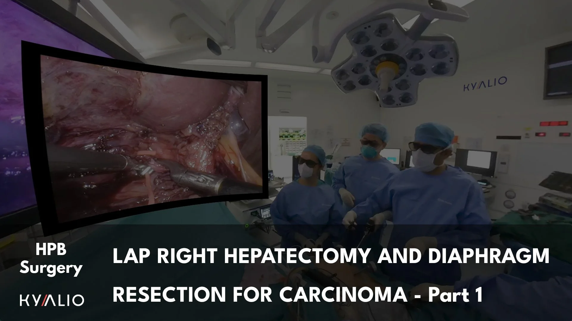 SG1_32_NUH_Shridhar_Right_Hepatectomy_for_Cancer_with_Diaphragm_Resection_22092021_P1.jpg