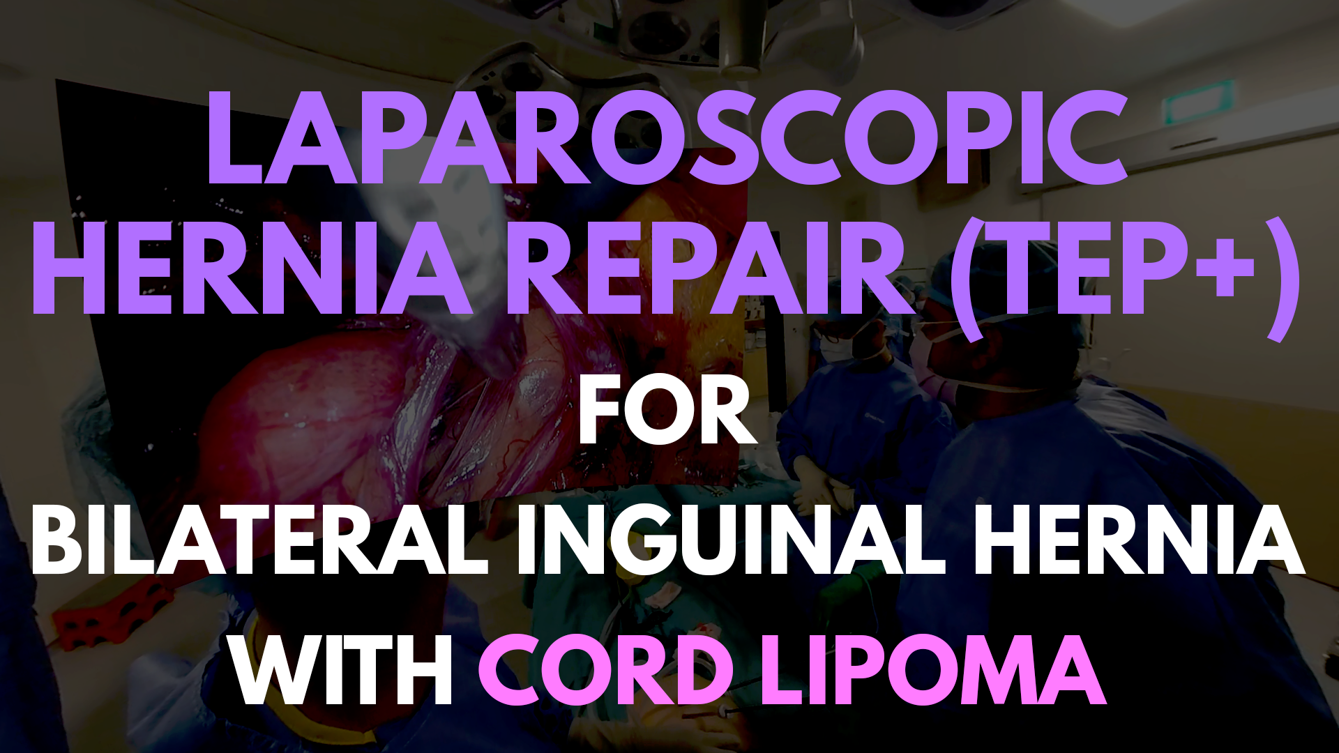 TEP+ for Bilateral Inguinal Hernia with Cord Lipoma.png