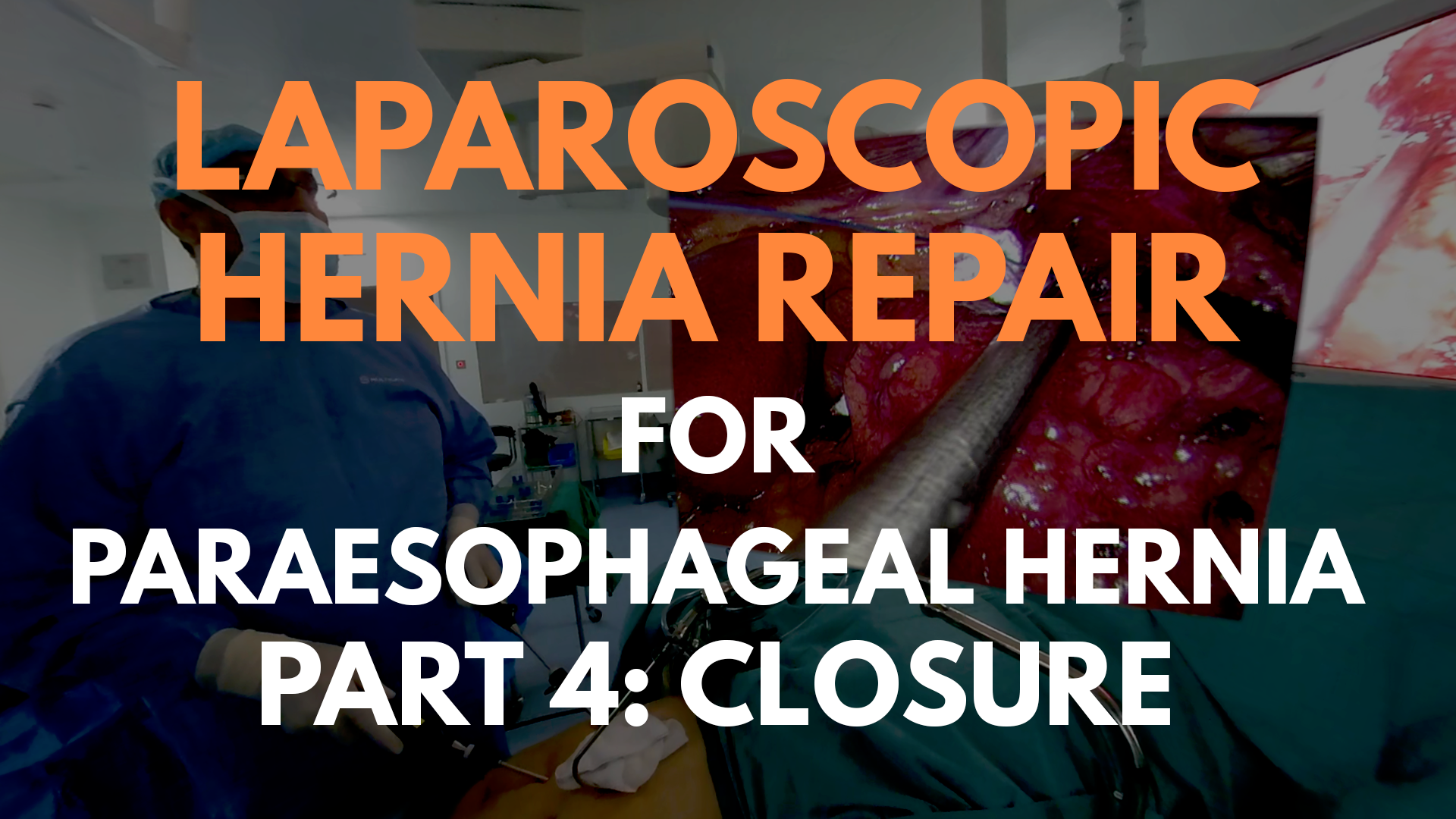Laparoscopic Hernia Repair for Paraesophageal Hernia_part 4.png