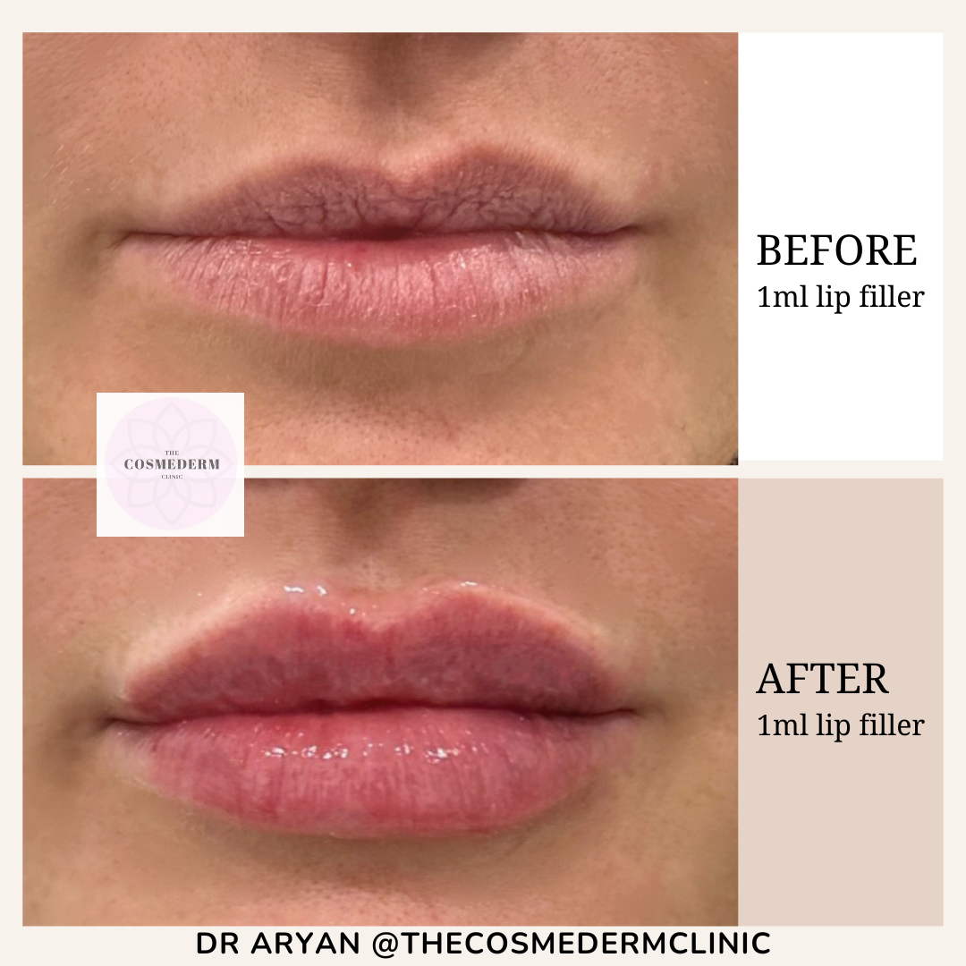 1ml lip filler - 5.PNG