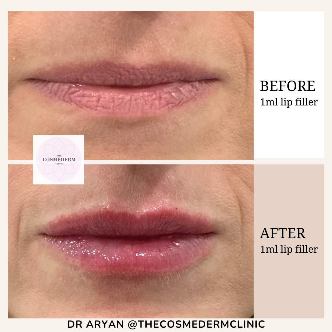 1ml lip filler - 3.PNG