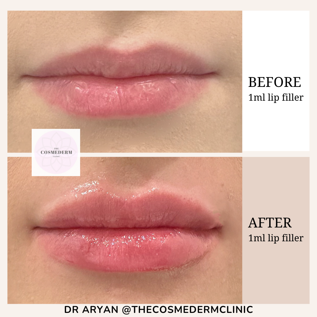 1ml lip filler - 7.PNG