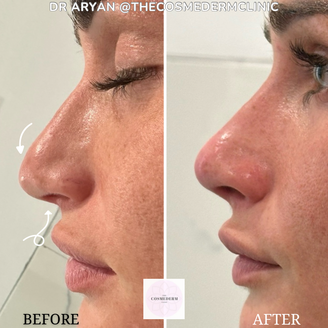 1ml filler - 20.PNG