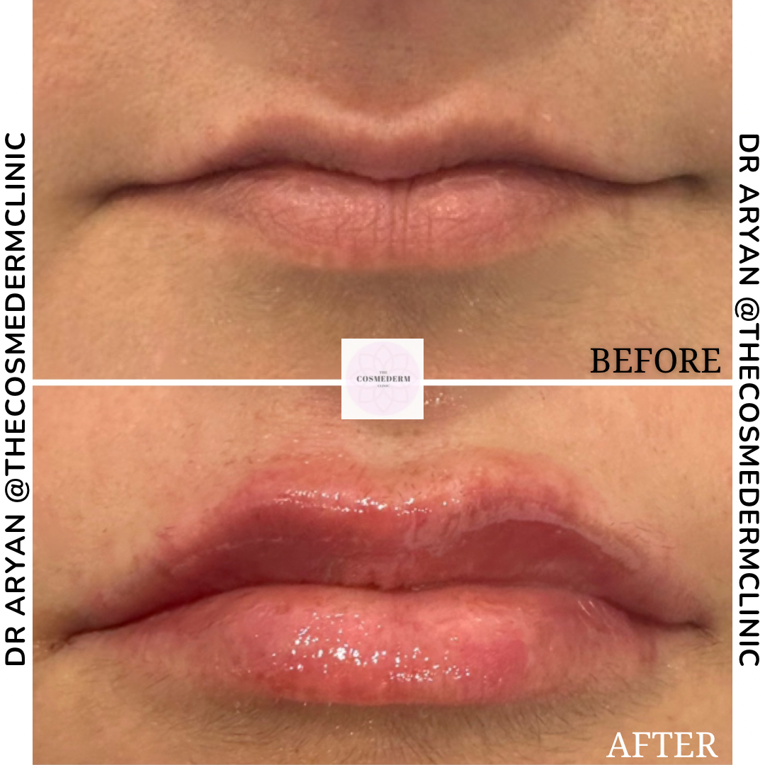 1ml filler.PNG