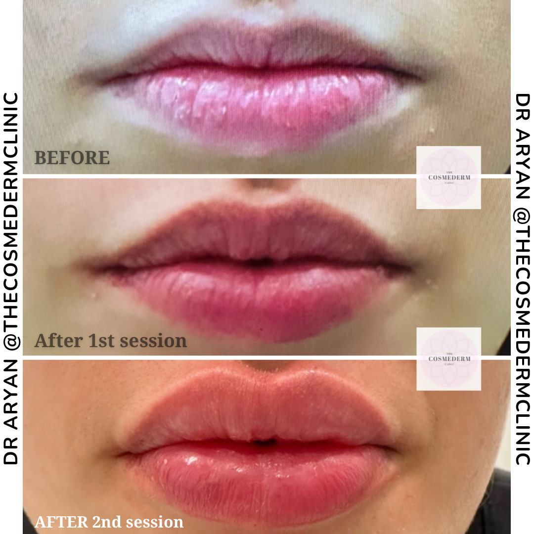 1ml filler 2.PNG