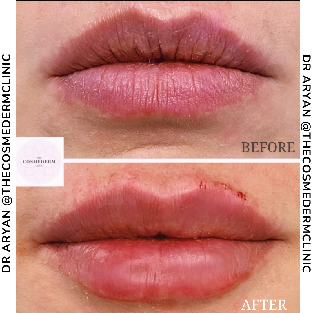 1ml filler.PNG