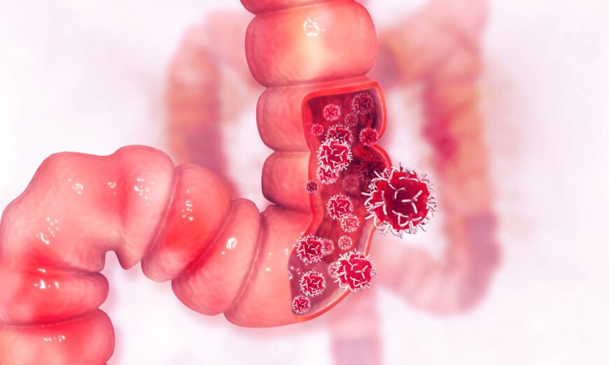 Study Links Popular Food Additive to Colon Cancer