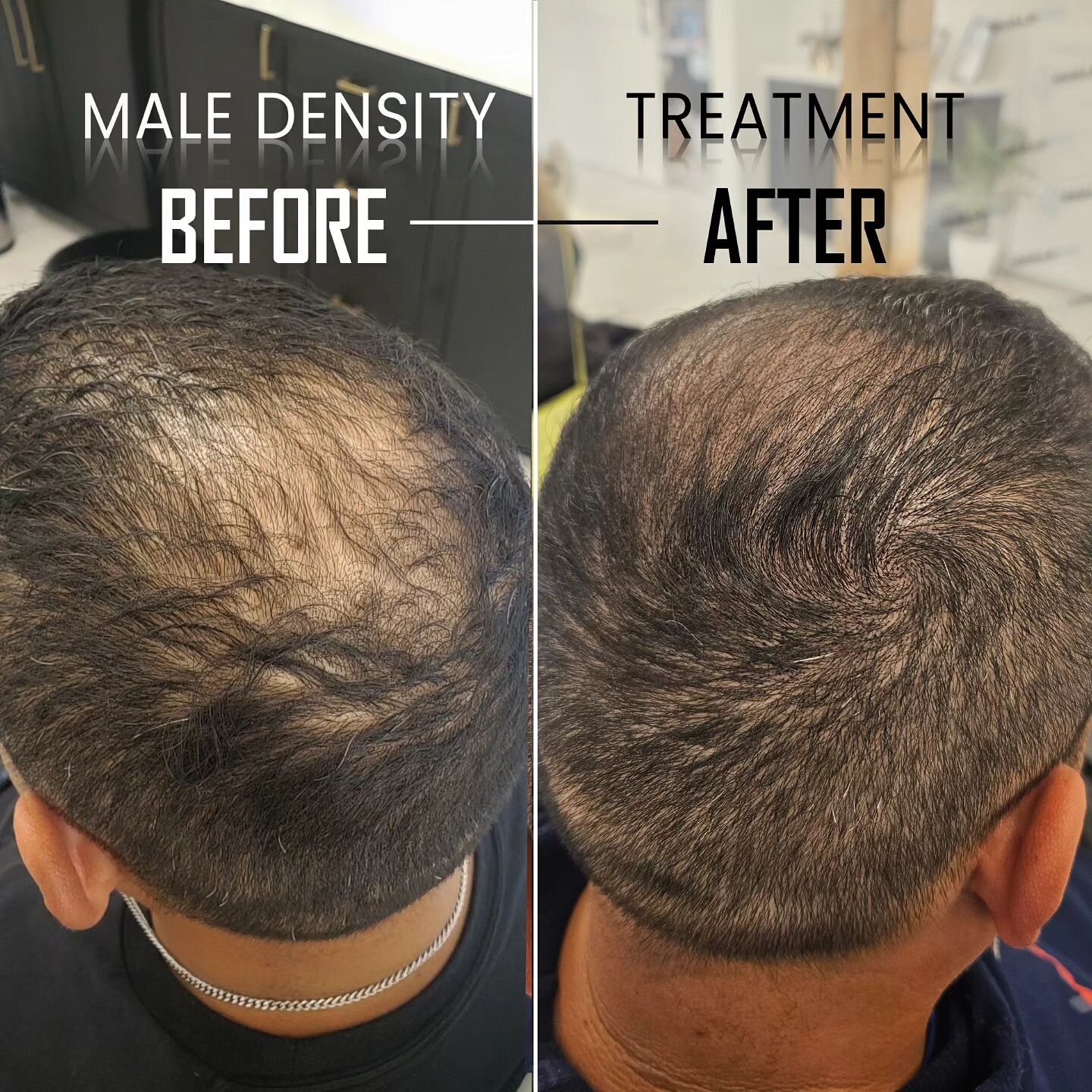 💥Another density treatment💥 Taking off that edge and lightness in the scalp, making the thinning area much less noticeable 💯

#smp #density #densitysmp #hairtattoo #scalptattoo #hairtransformation #hairlosstreatment #tattoo #midwesttattoo #midwest