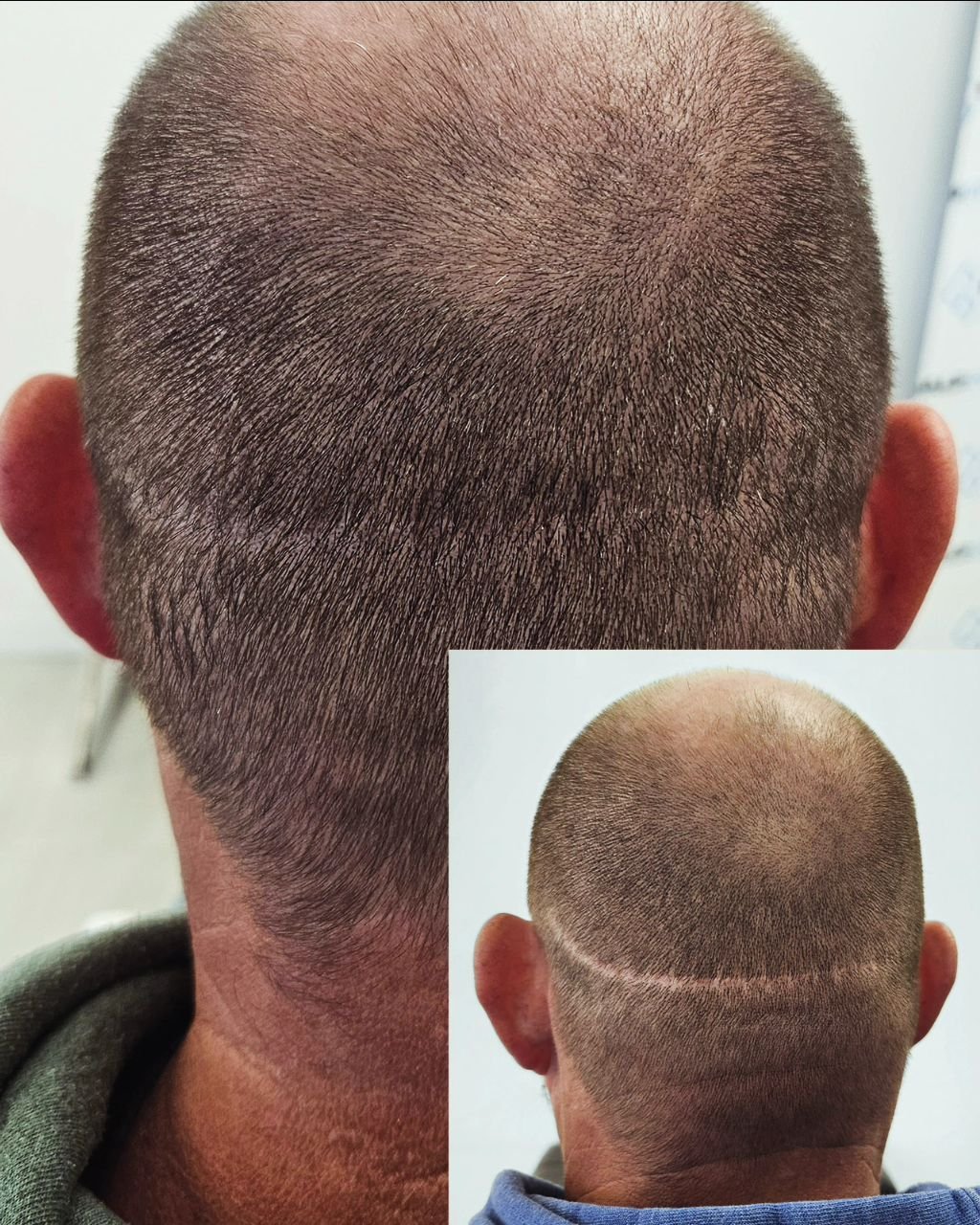 💥Another successful FUT scar coverup! 💥See the difference from start to finish. An SMP procedure is amazing in covering up not only FUT and FUE scars...but amost any scar that's within the scalp area💯💈✌️

#futscar #smp #siouxfallshair #midwesthai