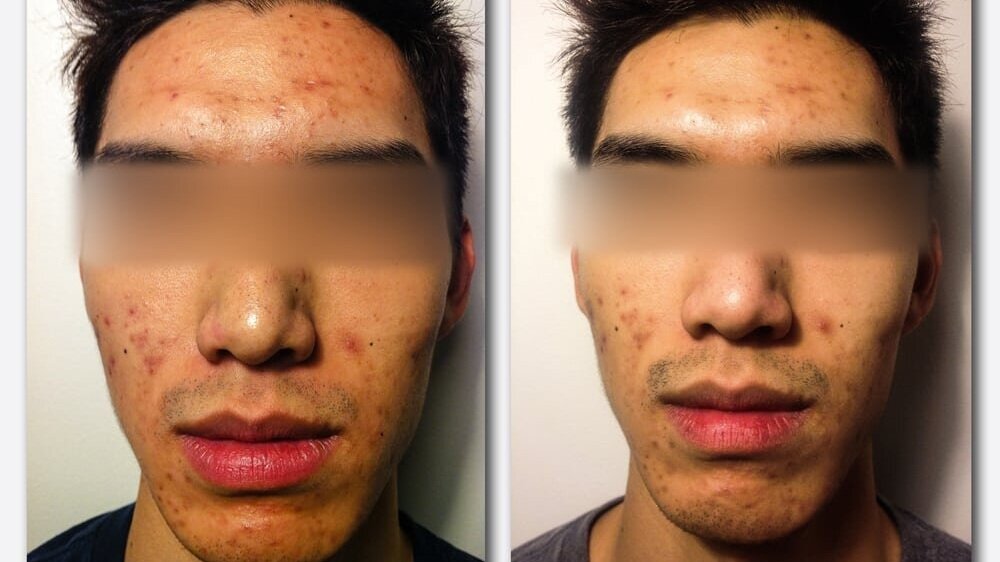 acne4.jpg