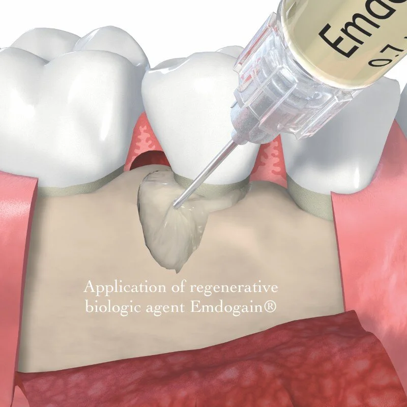 Application-of-regenerative-biologic-agent-Emdogain.jpg