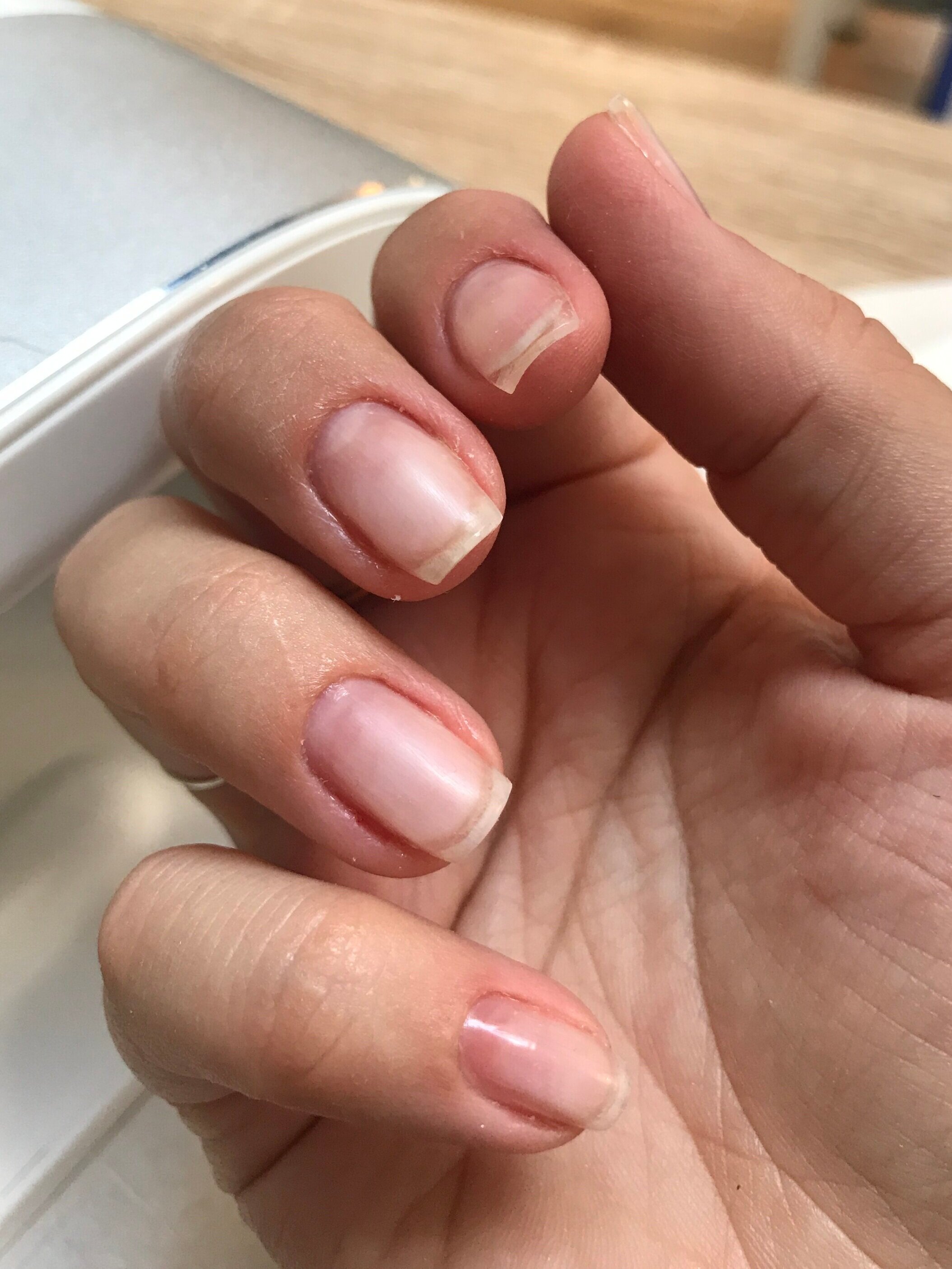 What Causes Fungus to Grow Under Acrylic Nails, and How Do You Treat It? |  BLAC Detroit