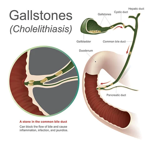 Gallbladder Surgery Ballarat — Specialist Centre Ballarat · General ...