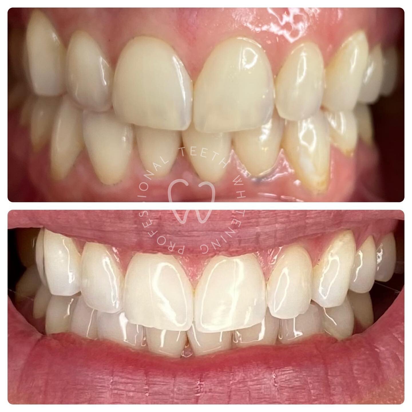 🦷
Let&rsquo;s talk teeth not just about whitening but oral hygiene /dental hygiene. 
◾️
It&rsquo;s easy to get a whitening treatment , it&rsquo;s easy to get to your desired shade  and it can be easy to maintain it ! 
As everything nothing lasts for