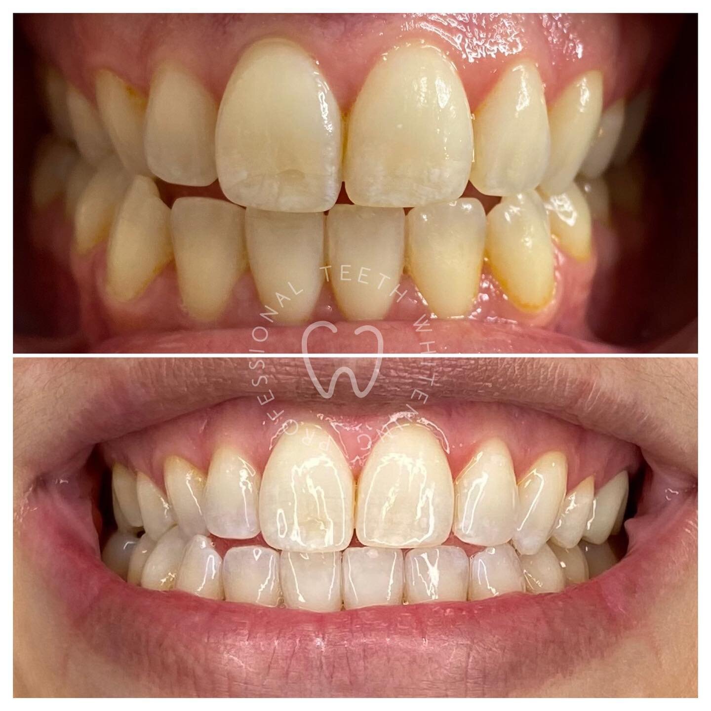 What&rsquo;s your Whyte ?
▫️
▫️
Regardless what it is we are the best at getting your teeth to the shade you desire. Pain free enamel safe &amp; best of all 60 minutes or less . Trust the process 
▫️
▫️
Whyte Whitening Bar 
850 The Queensway Etobicok