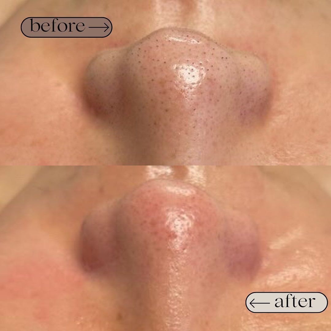 Check out these @hydrafacial extractions after just one treatment 🤗

If your pores look like the before and you would like to have them cleaned out, come on in for a Hydrafacial treatment with one of our estheticians! 

We hope to see you soon 😉✨

